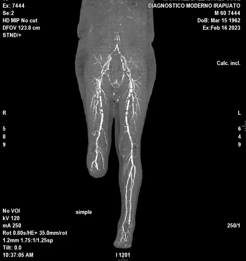 Estudios Radiologícos Angiotomografía Miembros Inferiores