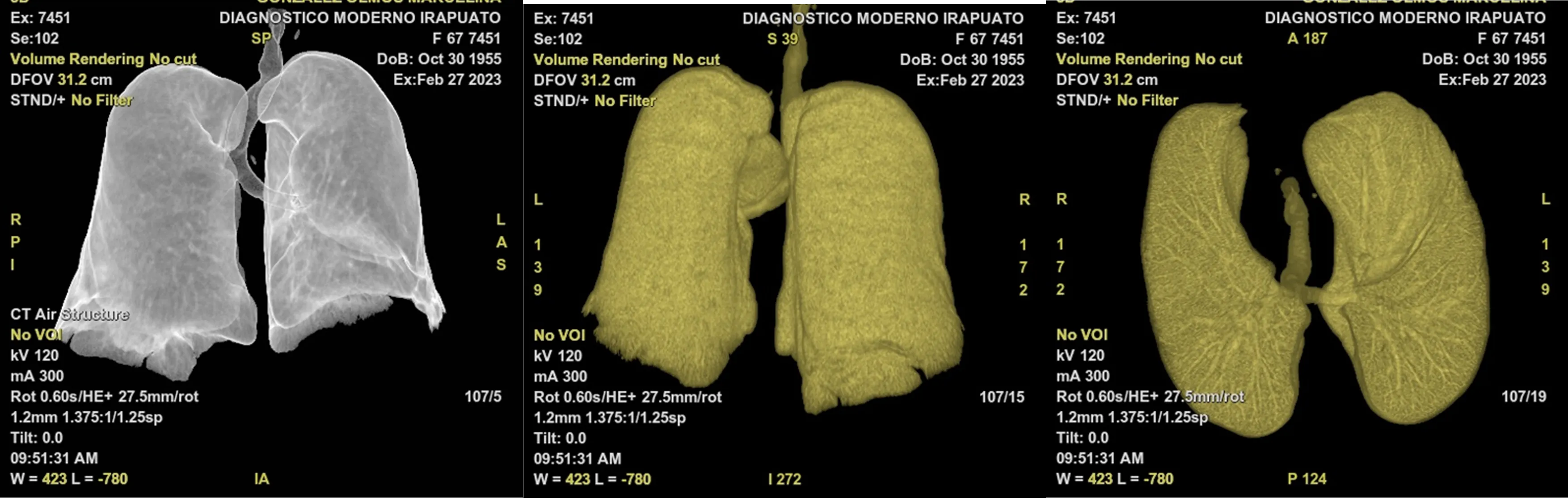 Estudios Radiologícos Tomografía del Torax Alta Resolución